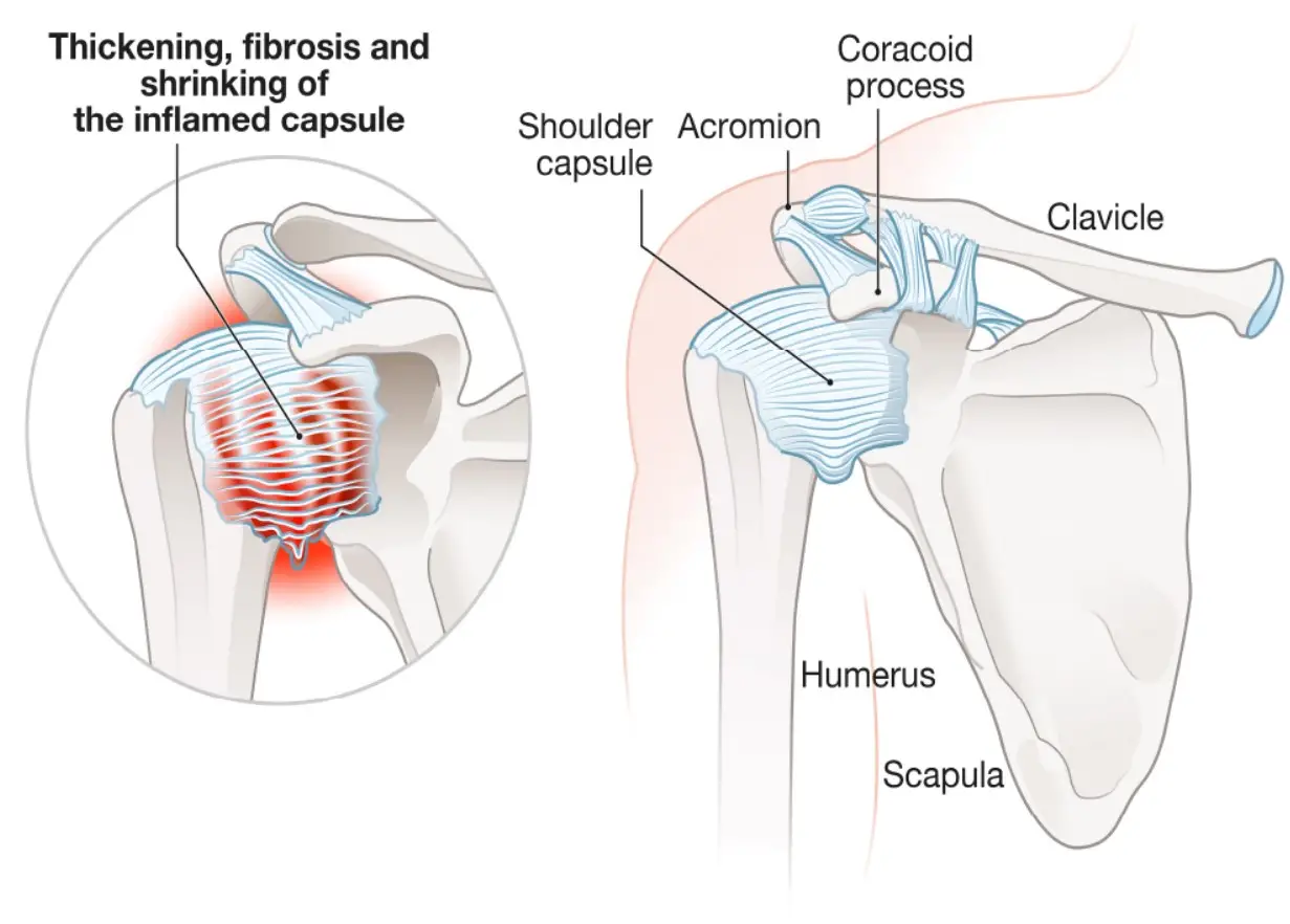 Distinguishing Frozen Shoulder