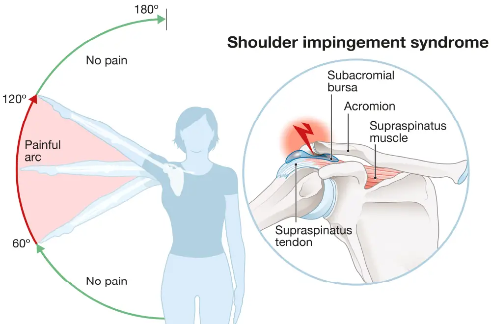 Rotator cuff treatment osteopth in wimbledon