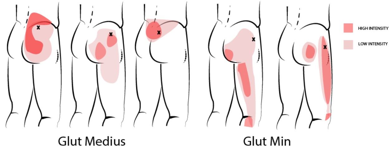 Understanding False sciatica