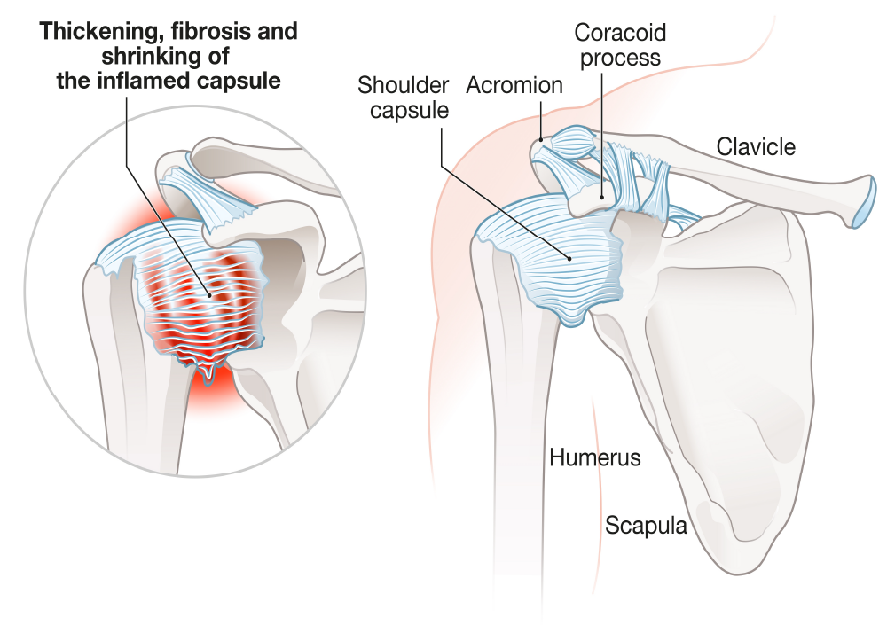 osteopthic treatment for frozen shoul;der 