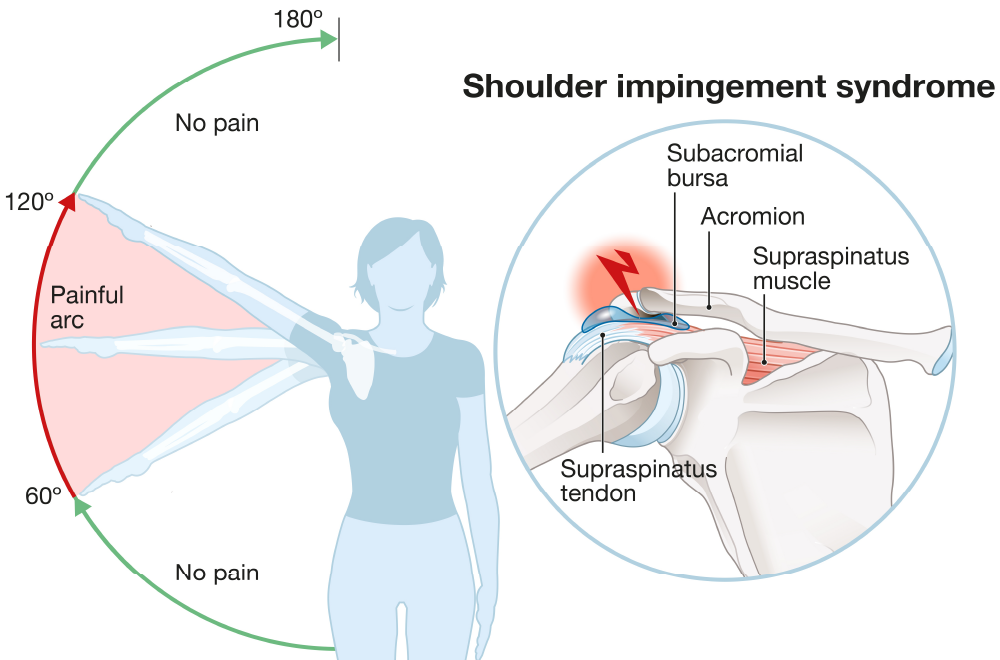 Rotator cuff treatment osteopth in wimbledon