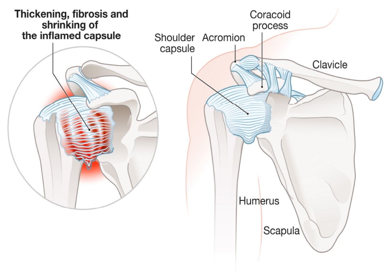 Distinguishing Frozen Shoulder