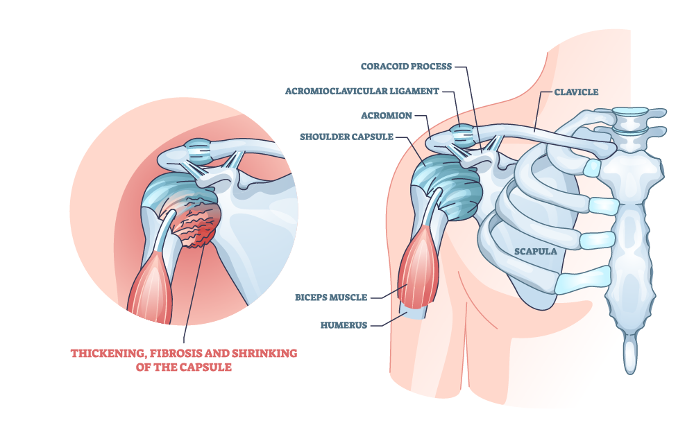 osetopathic treatment for capsule pain