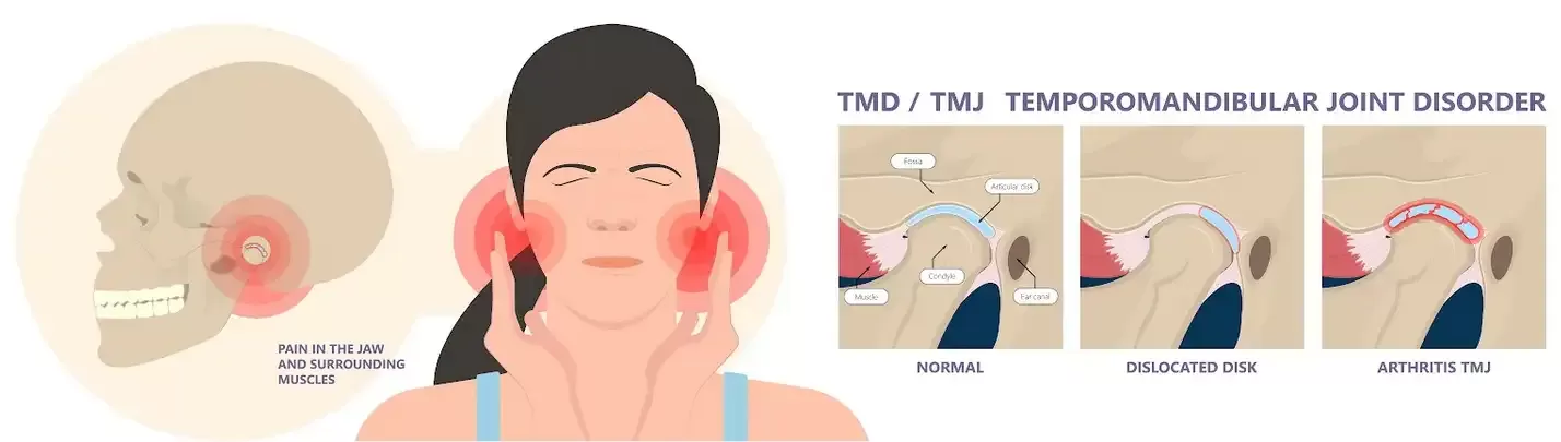 Understanding TMJ Disorders